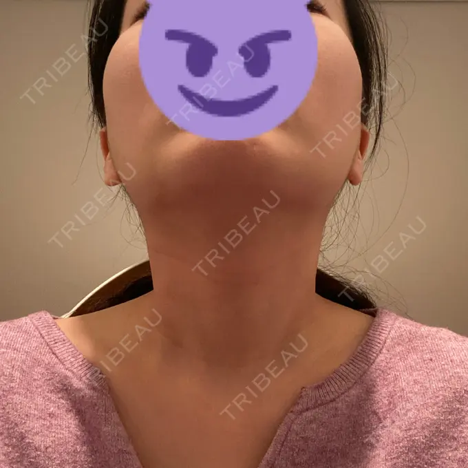 糸リフト / 脂肪吸引（顔） / ボトックス（エラ・小顔） RIVER CLINIC（リバークリニック） DAY 5 メイン用