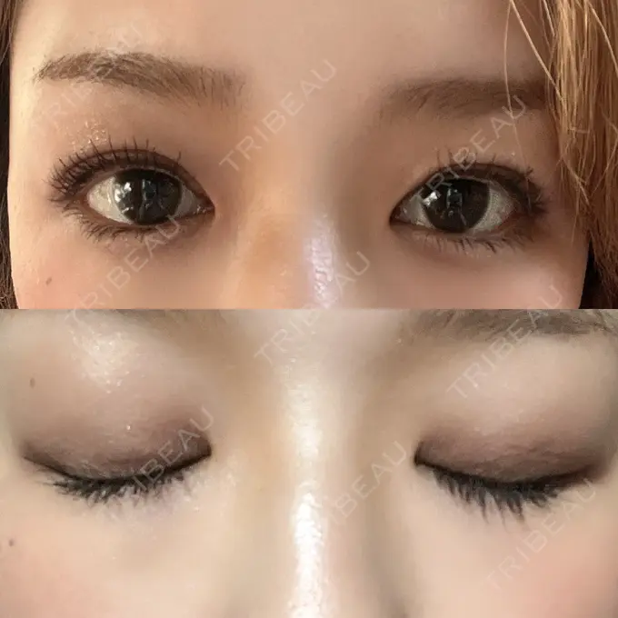 二重埋没 ルネッサンス美容外科医院 神戸院 DAY 7 メイン用