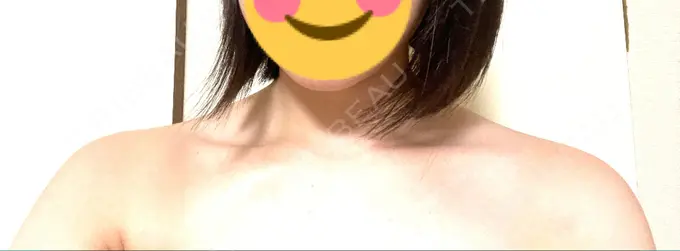 ボトックス（肩） MYCLINIC 西新宿 DAY 7 メイン用