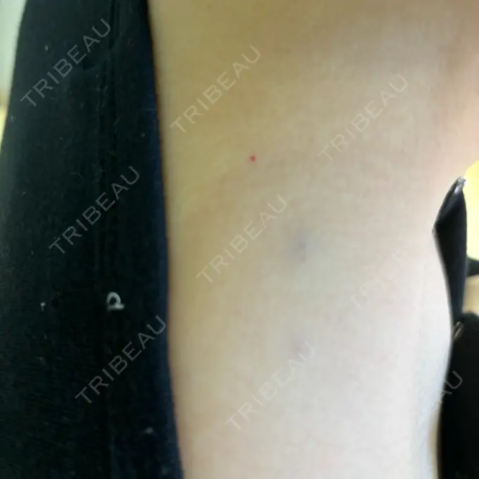 ボトックス（あご） / ボトックス（エラ・小顔） / ボトックス（肩） M'sクリニック【エムズクリニック】 DAY 1 メイン用