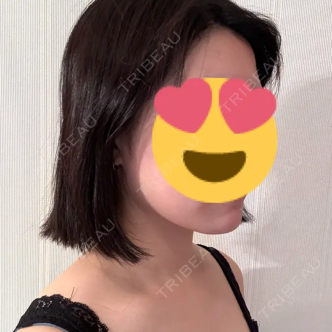 ボトックス（あご） / ボトックス（エラ・小顔） / ボトックス（肩） M'sクリニック【エムズクリニック】 DAY 33 メイン用