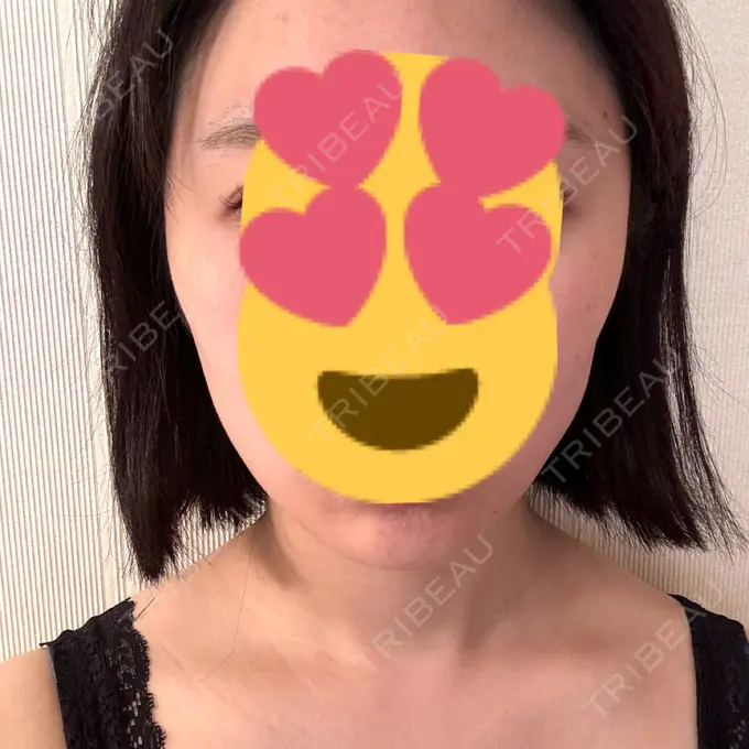 ボトックス（あご） / ボトックス（エラ・小顔） / ボトックス（肩） M'sクリニック【エムズクリニック】 DAY 33 メイン用