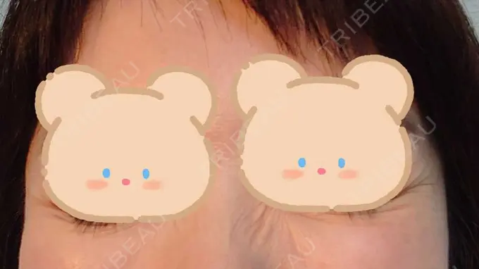 シワ取りボトックス / ボトックス（目尻） 湘南美容クリニック 川崎院 AFTER メイン用