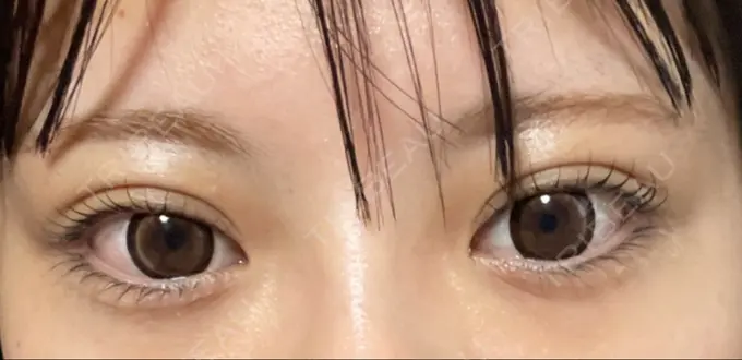 ボトックス（タレ目） 新宿TAクリニック AFTER メイン用