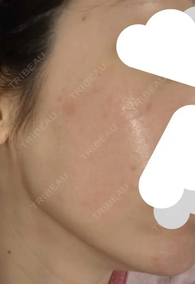 光治療（フォトフェイシャルなど） B-leafメディカル内科小児科クリニック AFTER メイン用