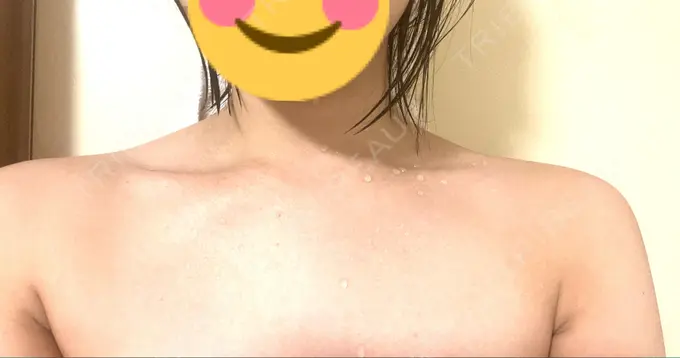 ボトックス（肩） MYCLINIC 西新宿 DAY 8 メイン用