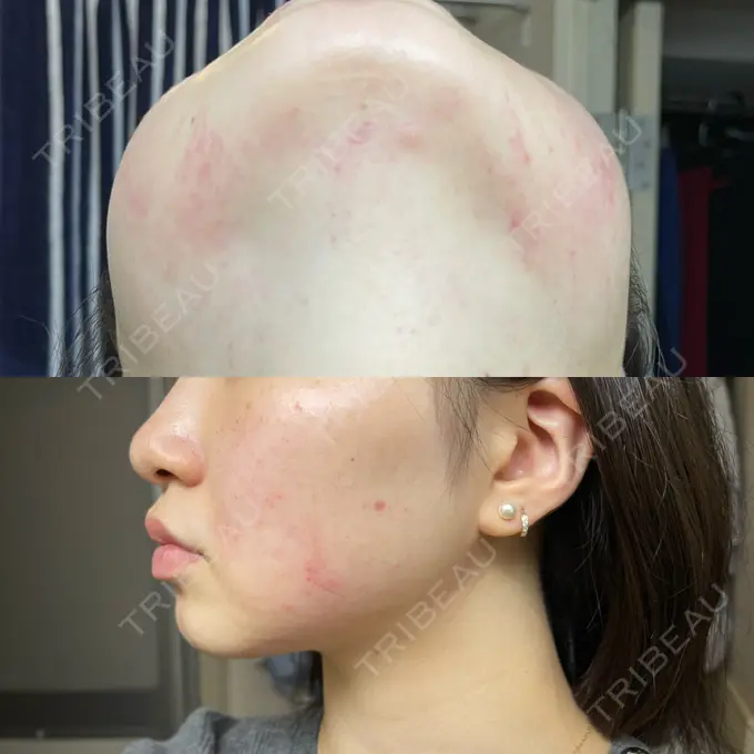 RF（高周波）たるみ治療 ライブリークリニック 浜松町院 DAY 0 メイン用