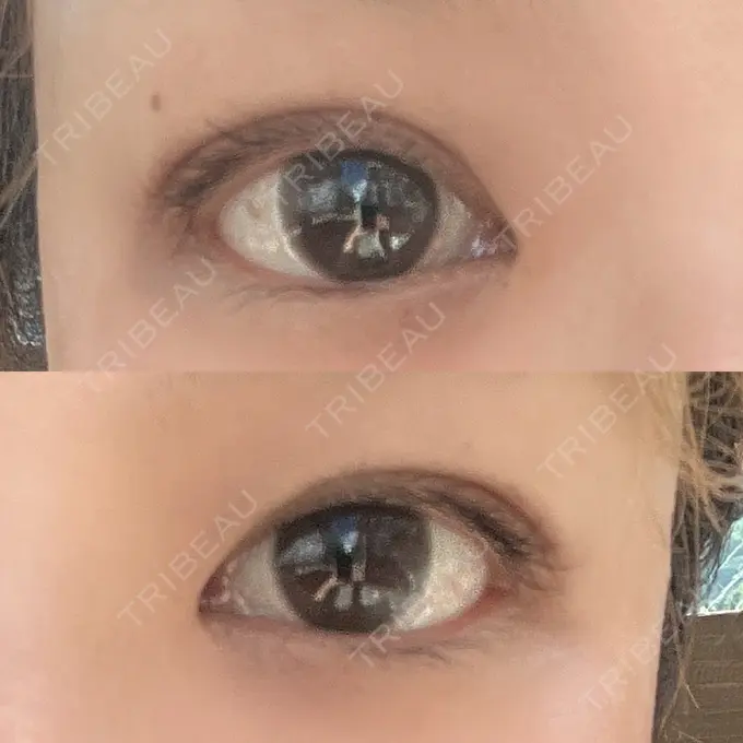 二重埋没 ルネッサンス美容外科医院 神戸院 DAY 8 メイン用