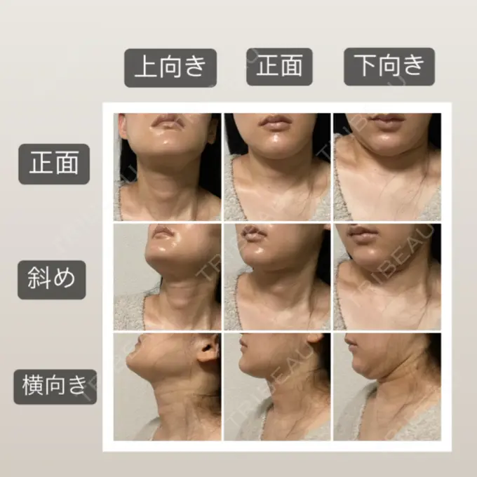 脂肪吸引（顔） 湘南美容クリニック 秋葉原院 DAY 49 メイン用