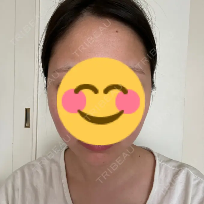 糸リフト / 脂肪吸引（顔） Casa de GRACIA GINZA 【カーサデグラシアギンザ】 AFTER メイン用