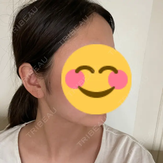 糸リフト / 脂肪吸引（顔） Casa de GRACIA GINZA 【カーサデグラシアギンザ】 DAY 252 メイン用