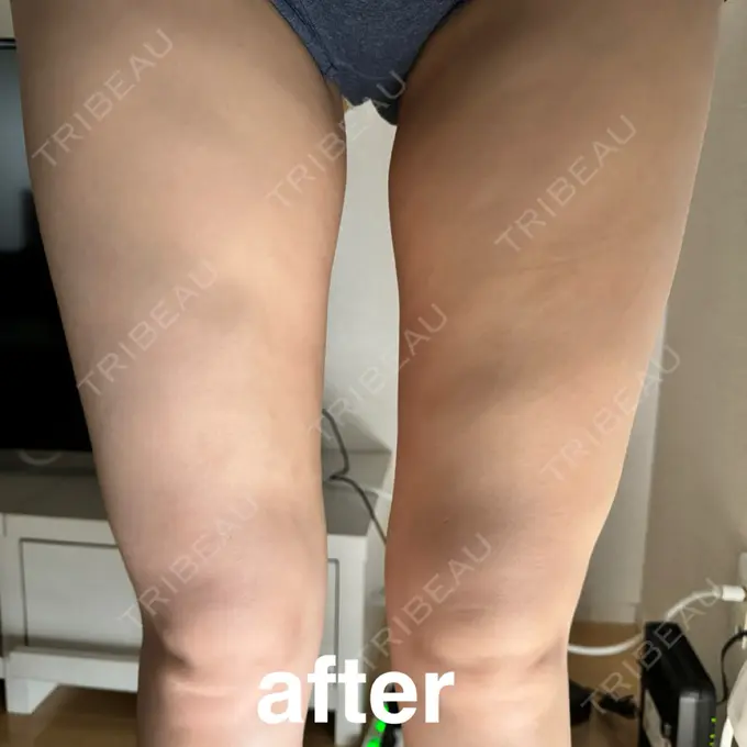 脂肪吸引（脚） / 医療痩身（太もも） Mods Clinic（モッズクリニック） 大阪院 DAY 35 メイン用