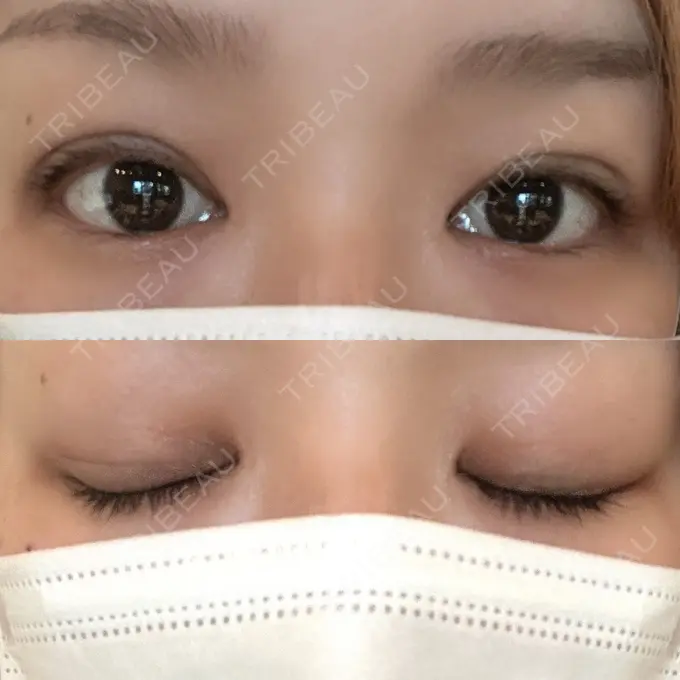 二重埋没 ルネッサンス美容外科医院 神戸院 AFTER メイン用