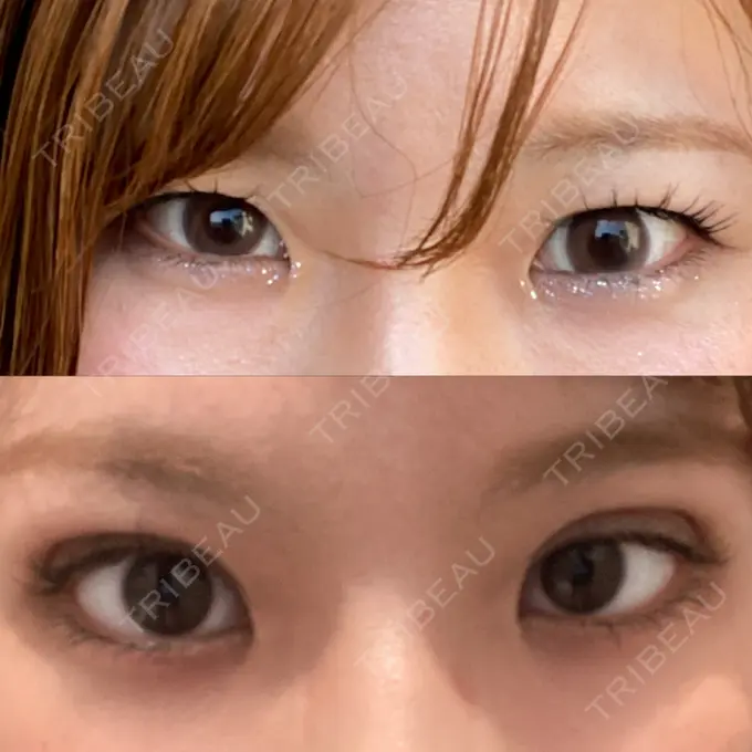 二重埋没 / 脂肪溶解注射（顔） / ボトックス（眉間） / ボトックス（額） / その他（鼻） X CLINIC 恵比寿院 DAY 0 メイン用