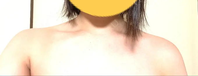 ボトックス（肩） MYCLINIC 西新宿 DAY 9 メイン用