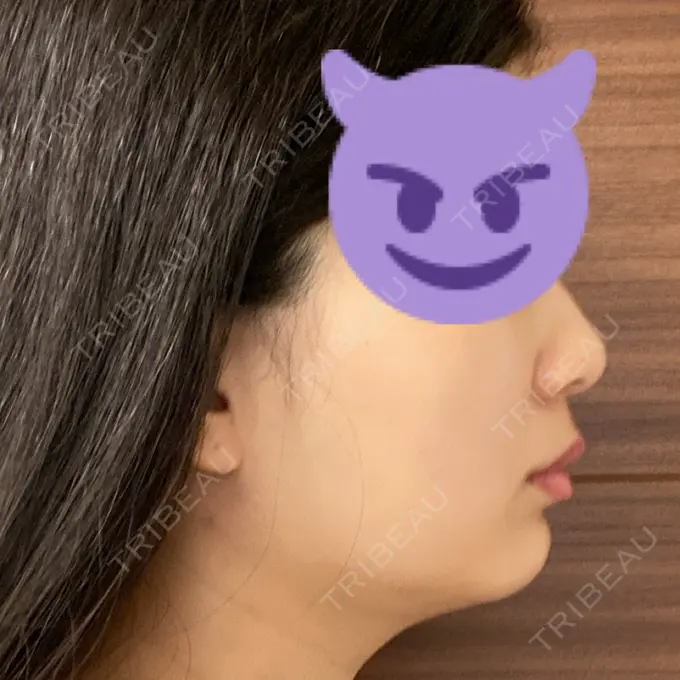 糸リフト / 脂肪吸引（顔） / ボトックス（エラ・小顔） RIVER CLINIC（リバークリニック） DAY 8 メイン用