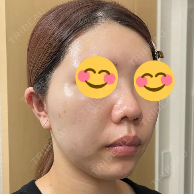 水光注射（ハリ・美肌） / その他（肌） / ピーリング（ニキビ・毛穴） / RF（高周波）たるみ治療 / その他（目元） / その他（鼻） バログ医院 江南院 DAY 12 メイン用