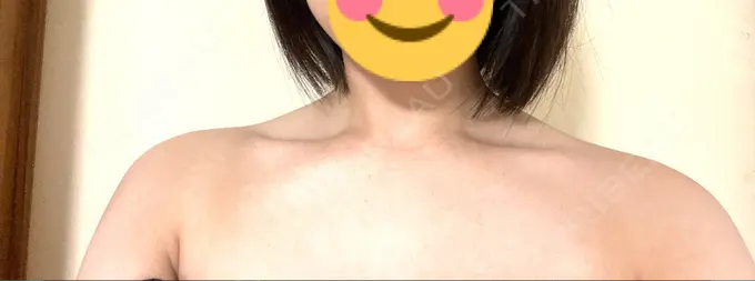 ボトックス（肩） MYCLINIC 西新宿 AFTER メイン用