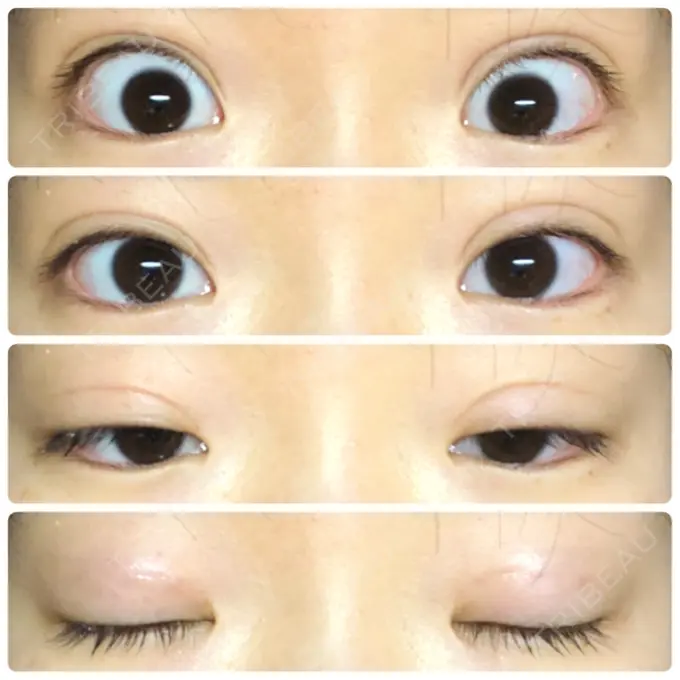 二重埋没 湘南美容クリニック 新宿本院 DAY 17 メイン用