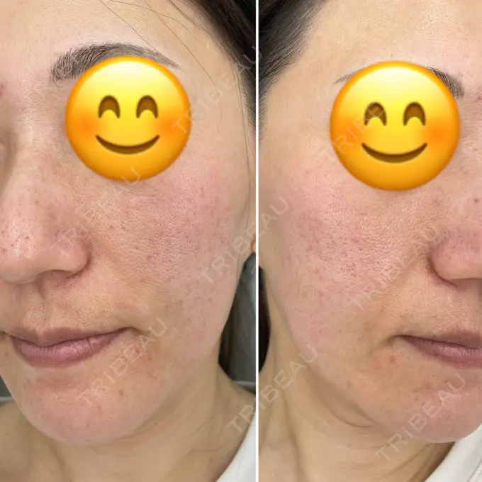 その他（肌） 新宿ラクル美容外科クリニック 新宿院 AFTER メイン用