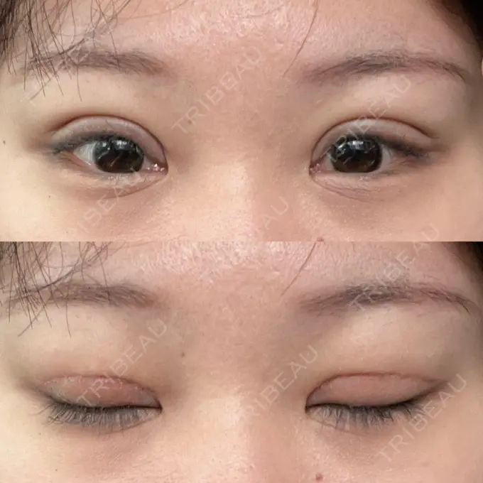 二重切開 / 眼瞼下垂（切開） エターナル美容クリニック DAY 21 メイン用
