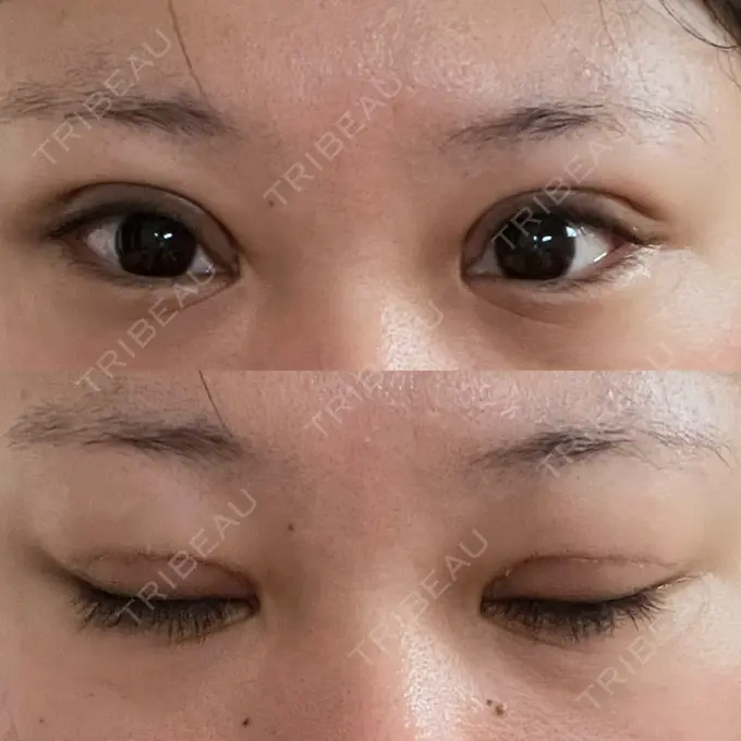 二重切開 / 眼瞼下垂（切開） エターナル美容クリニック DAY 23 メイン用