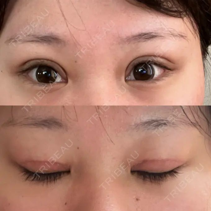 二重切開 / 眼瞼下垂（切開） エターナル美容クリニック DAY 27 メイン用