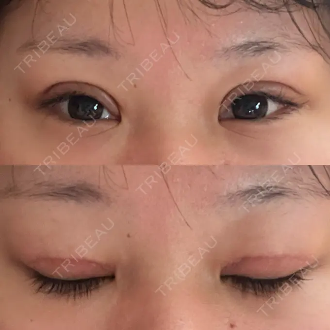 二重切開 / 眼瞼下垂（切開） エターナル美容クリニック DAY 27 メイン用