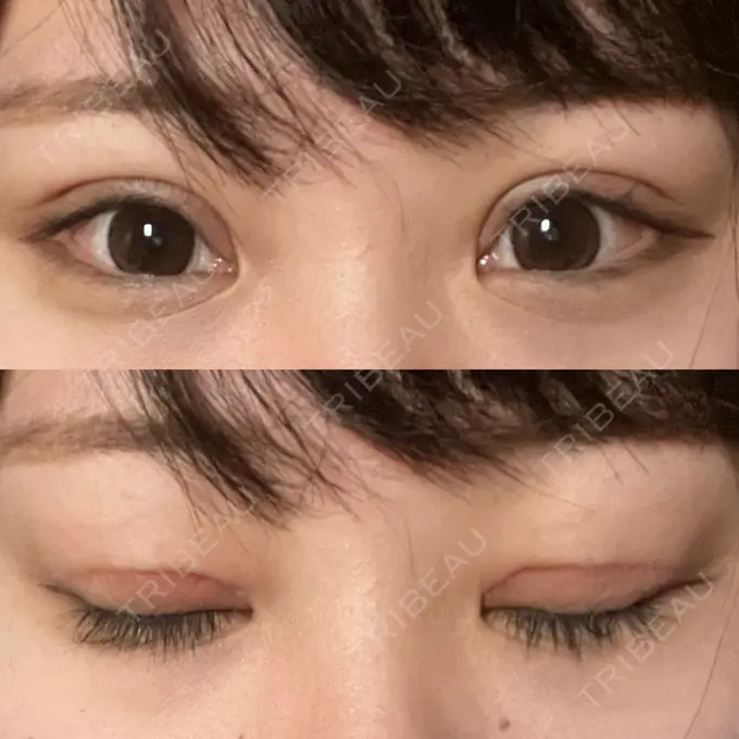 二重切開 / 眼瞼下垂（切開） エターナル美容クリニック DAY 28 メイン用
