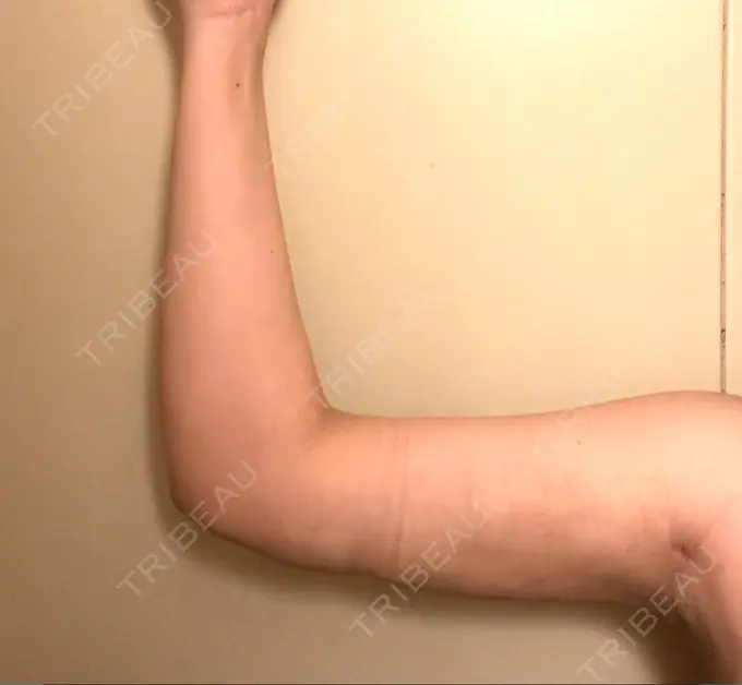 脂肪吸引（二の腕） アムルーズ美容外科クリニック 横浜院 DAY 28 メイン用