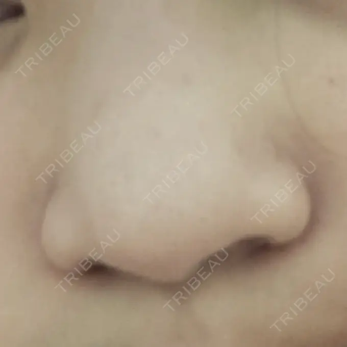 脂肪吸引注射（顔） / その他（鼻） 吉祥寺アイビークリニック DAY 1 メイン用