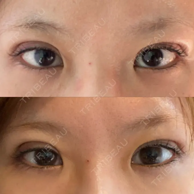 二重埋没 / 脂肪溶解注射（顔） / ボトックス（眉間） / ボトックス（額） / その他（鼻） X CLINIC 恵比寿院 DAY 3 メイン用