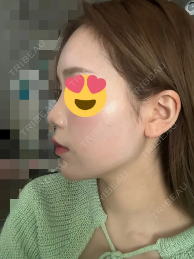 糸リフト / ヒアルロン酸注入（あご） / ボトックス（肩） TCB東京中央美容外科 心斎橋院 DAY 15 メイン用