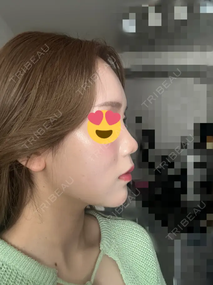 糸リフト / ヒアルロン酸注入（あご） / ボトックス（肩） TCB東京中央美容外科 心斎橋院 DAY 15 メイン用