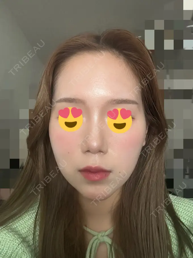 糸リフト / ヒアルロン酸注入（あご） / ボトックス（肩） TCB東京中央美容外科 心斎橋院 DAY 15 メイン用