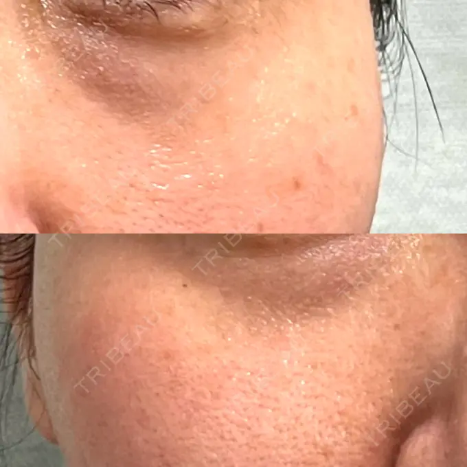 リジュラン 湘南美容クリニック 新宿南口院 DAY 7 メイン用