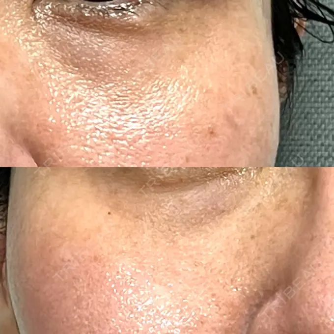 リジュラン 湘南美容クリニック 新宿南口院 DAY 9 メイン用