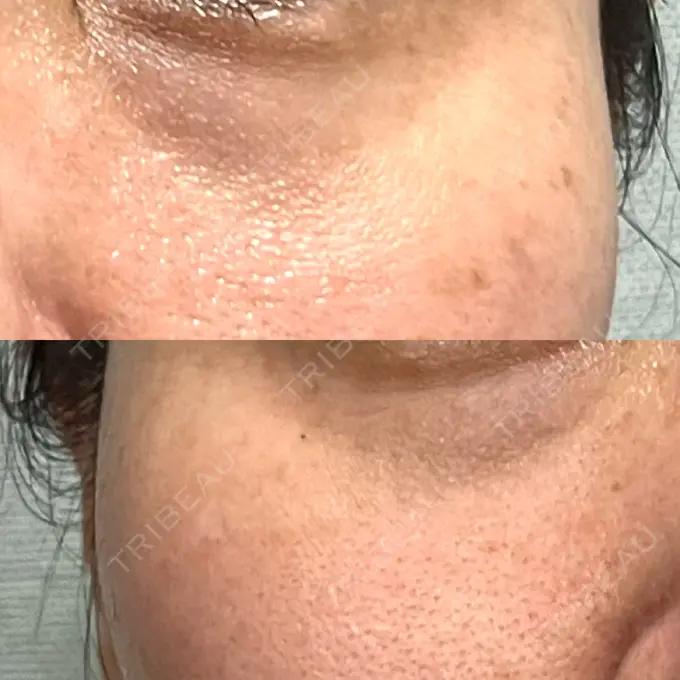 リジュラン 湘南美容クリニック 新宿南口院 DAY 11 メイン用