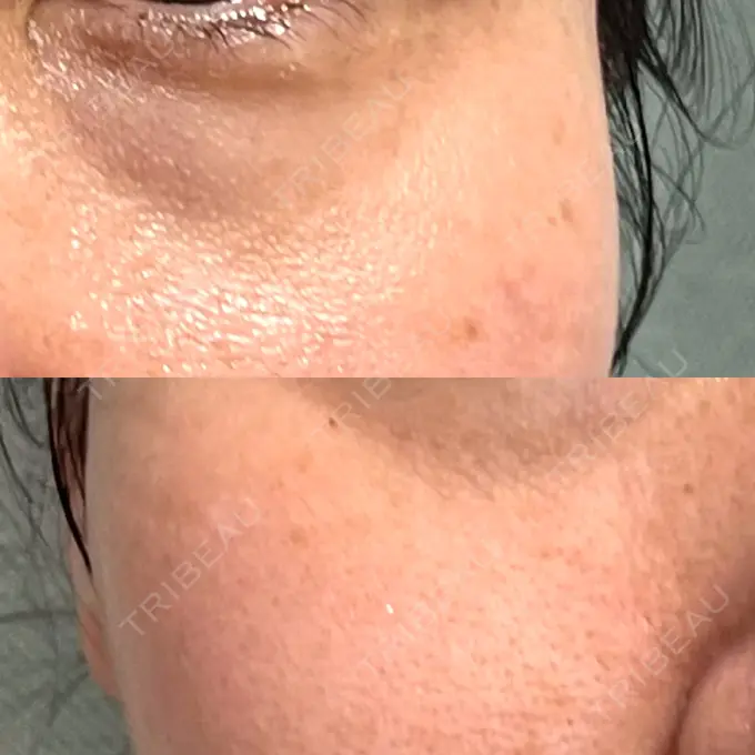 リジュラン 湘南美容クリニック 新宿南口院 DAY 12 メイン用