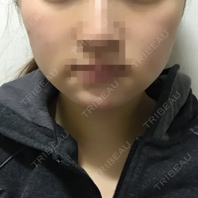 骨削り（エラ） / 骨削り（頬） シナジー整形外科 DAY 8 メイン用