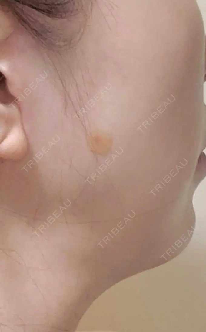 ほくろ・いぼ除去レーザー（肌） Mavie Beauty Clinic （マヴィービューティークリニック） DAY 9 メイン用