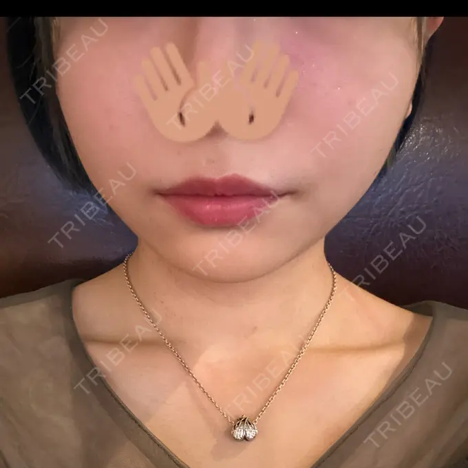 赤み除去レーザー ziz CLINIC AFTER メイン用