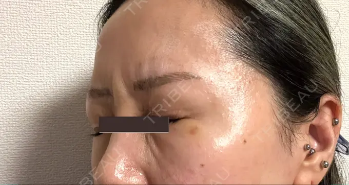 ボトックス（エラ・小顔） / ボトックス（眉間） / ボトックス（目尻） / ボトックス（額） 川越TAクリニックアソシエ DAY 7 メイン用