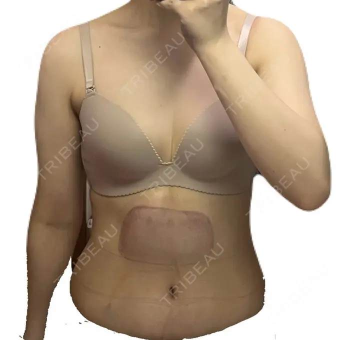 脂肪冷却（お腹） DMTC CLINIC 日本橋院 DAY 0 メイン用