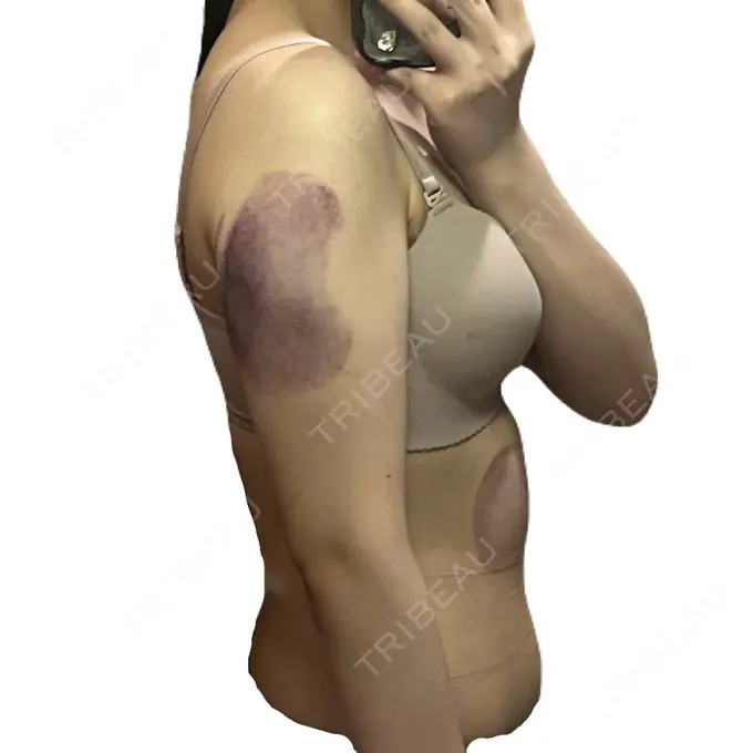 脂肪冷却（お腹） DMTC CLINIC 日本橋院 DAY 0 メイン用