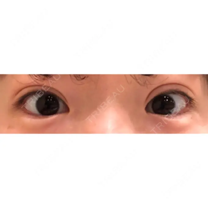 ヒアルロン酸注入（涙袋） フィラークリニック 新宿院 DAY 0 メイン用