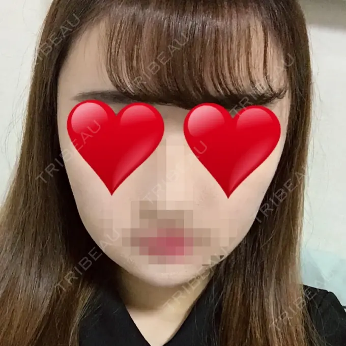 骨削り（エラ） / 骨削り（頬） シナジー整形外科 DAY 11 メイン用