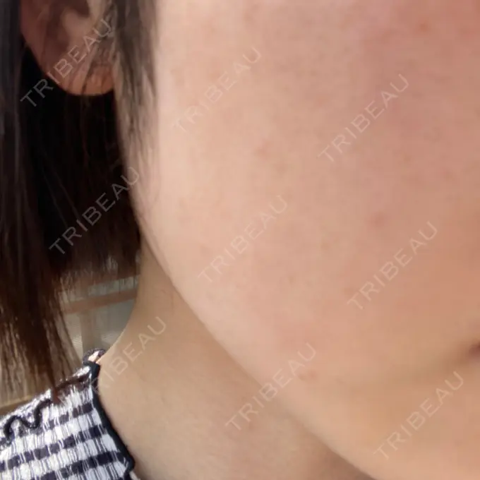 医療脱毛（顔） 共立美容外科 熊本院 AFTER メイン用