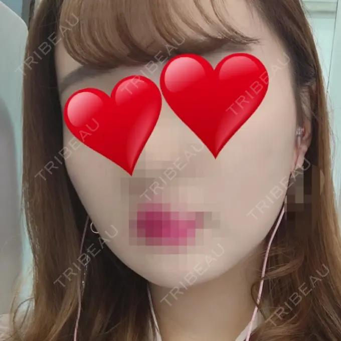 骨削り（エラ） / 骨削り（頬） シナジー整形外科 DAY 23 メイン用