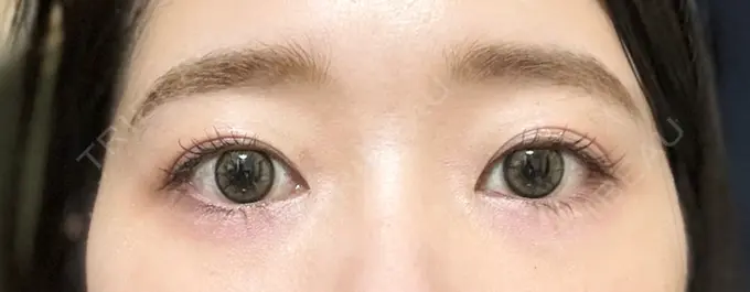 二重埋没 湘南美容クリニック 町田院 DAY 130 メイン用